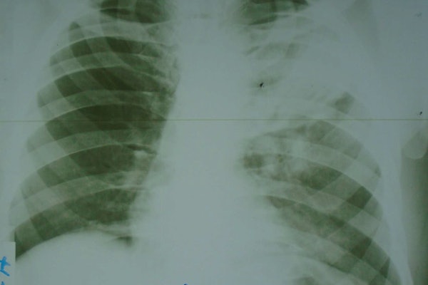 A sample input analyzed by the AI model. The film chest x-ray was photographed with a Sony Cyber-shot 20.1 MP digital camera.