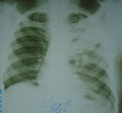 AI detects tuberculosis on photos of chest x-rays