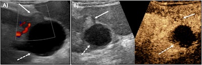 CEUS outshines color Doppler imaging for indeterminate kidney lesions