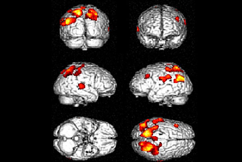 2026 01 30 Jalzdisease Ai Spect Models Detect Alzheimers Michopoulou Thumbnail
