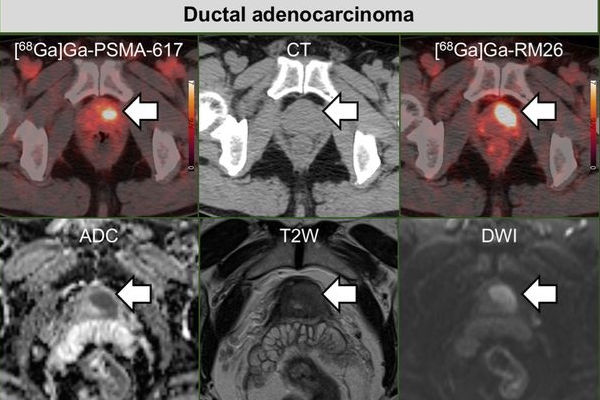 2026 02 06 Psma Pet Ct Thumbnail