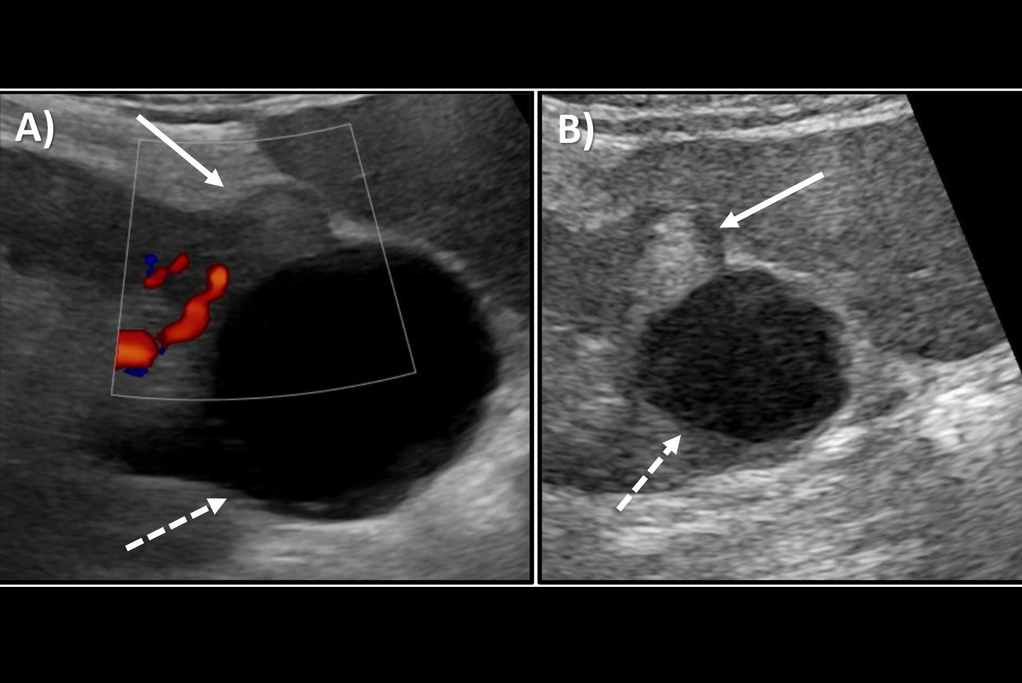 2026 02 12 Wfumb Sertic Ceus Kidney Lesions Thumbnail