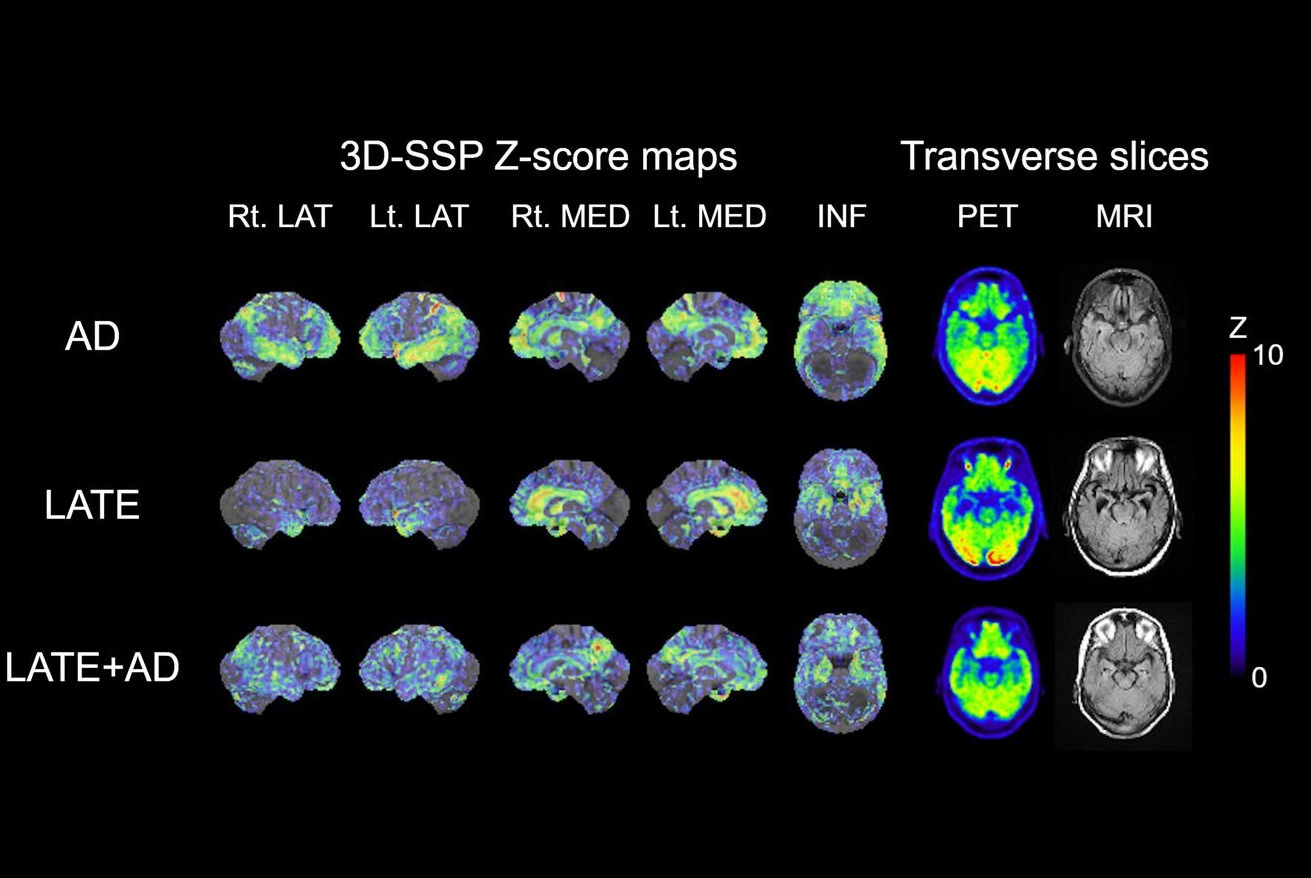 2026 02 25 Alzheimers Late Pet Mri Thumbnail