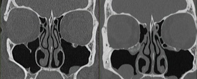 47-year-old’s sinuses evaluation using both energy-integrating detector (EID), left, and PCCT, right, scanners. Coronal images are shown. PCCT examination included additional dose reduction methods including tin filtration and ultrahigh-resolution acquisition. Volume computed tomography dose index is lower for PCCT than for EID scanner (9 vs 26 mGy, respectively); yet, PCCT image has less noise. EID CT examination was performed on Siemens Sensation 64 scanner with following parameters: detector configuration, 32x0.6 mm; z-flying focal spot (64x0.6 mm); tube potential, 120 kV; rotation time, 1 second; helical pitch, 0.9; effective mAs, 170; kernel, H70; slice thickness, 0.75 mm; matrix, 512. PCCT examination was performed on Siemens NAEOTOM Alpha scanner with following parameters: detector configuration, 120x0.2 mm; tube voltage, 100 kV with added tin filter; rotation time, 1 second; helical pitch, 0.85; kernel, Hr72 with QIR strength setting of 3; slice thickness, 0.6; mm; matrix, 1024.
