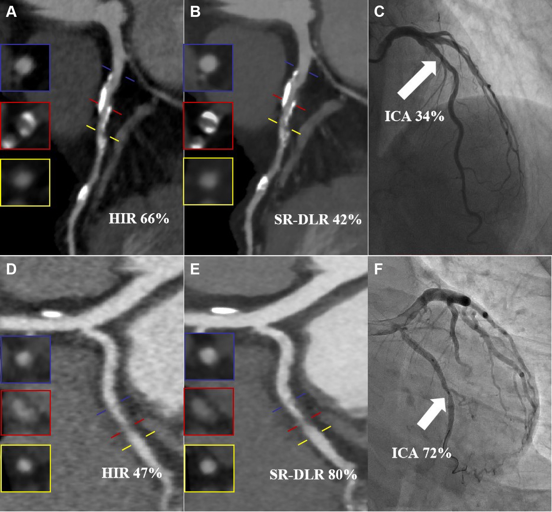 Images from two representative cases. (A-C) Images in an 82-year-old man with a calcified plaque in the proximal segment of the left anterior descending artery. (A, B) Curved planar reconstruction images from CCTA with (A) hybrid iterative reconstruction (HIR) and (B) super-resolution deep learning reconstruction (SR-DLR) show that the measured PDS was 66% for the HIR image and 42% for the SR-DLR image. (C) Quantitative analysis of the invasive coronary angiography (ICA) image (reference standard) revealed a PDS of 34% (arrow). (D-F) Images in a 37-year-old woman with a noncalcified plaque in the middle segment of the left circumflex artery. (D, E) Curved planar reconstruction images from CCTA with (D) HIR and (E) SR-DLR show that the measured PDS was 47% for the HIR image and 80% for the SR-DLR image. (F) Quantitative analysis of the ICA image revealed a PDS of 72% (arrow). Blue, red, and yellow lines in A, B, D, and E represent the proximal reference point, stenosed lesion, and distal reference point, respectively, and the insets show the corresponding cross-sectional images.
