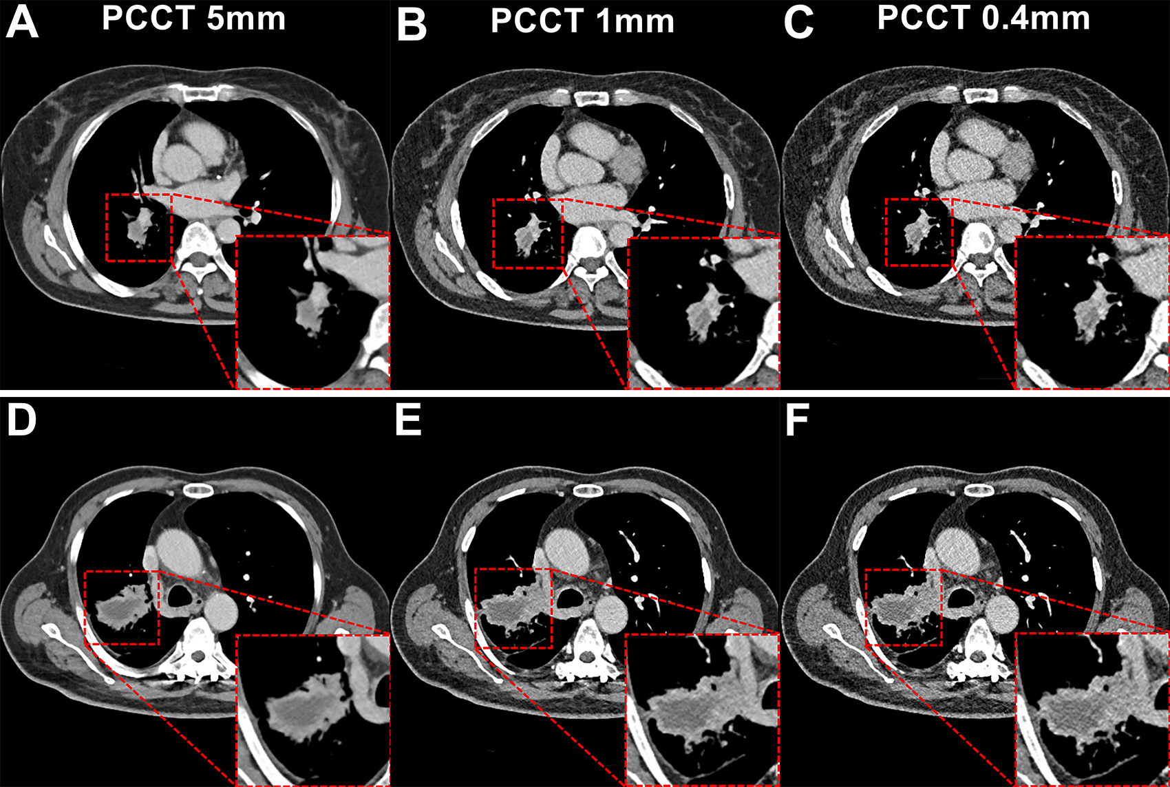 Subgroup analysis based on lesion size on PCCT images. The red outlined areas highlight the magnified images of lesions. (A-C) PCCT images in a 62-year-old woman with a body mass index (BMI) of 23.6, calculated as weight in kilograms divided by height in meters squared, who was diagnosed with adenocarcinoma. A lesion with a long diameter of 25 mm was identified in the right lower lobe on axial images acquired during the venous phase. For lesions less than or equal to 30 mm, decreasing section thickness improved boundary sharpness and contrast between the necrotic area and enhanced tissue, with optimal visualization at 0.4 mm. (D-F) PCCT images in a 66-year-old man with a BMI of 24.2 who was diagnosed with adenocarcinoma, revealing a lesion with a long diameter of 52 mm in the right lower lobe. For lesions greater than 30 mm, a section thickness of 1 mm demonstrated better contrast and clarity at the boundary of the necrotic area compared with 0.4 mm. This observation supported the selection of an appropriate section thickness for accurate quantification of necrotic regions within the lesion.
