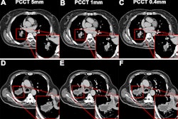 Subgroup analysis based on lesion size on PCCT images. The red outlined areas highlight the magnified images of lesions. (A-C) PCCT images in a 62-year-old woman with a body mass index (BMI) of 23.6, calculated as weight in kilograms divided by height in meters squared, who was diagnosed with adenocarcinoma. A lesion with a long diameter of 25 mm was identified in the right lower lobe on axial images acquired during the venous phase. For lesions less than or equal to 30 mm, decreasing section thickness improved boundary sharpness and contrast between the necrotic area and enhanced tissue, with optimal visualization at 0.4 mm. (D-F) PCCT images in a 66-year-old man with a BMI of 24.2 who was diagnosed with adenocarcinoma, revealing a lesion with a long diameter of 52 mm in the right lower lobe. For lesions greater than 30 mm, a section thickness of 1 mm demonstrated better contrast and clarity at the boundary of the necrotic area compared with 0.4 mm. This observation supported the selection of an appropriate section thickness for accurate quantification of necrotic regions within the lesion.