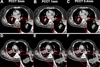 Subgroup analysis based on lesion size on PCCT images. The red outlined areas highlight the magnified images of lesions. (A-C) PCCT images in a 62-year-old woman with a body mass index (BMI) of 23.6, calculated as weight in kilograms divided by height in meters squared, who was diagnosed with adenocarcinoma. A lesion with a long diameter of 25 mm was identified in the right lower lobe on axial images acquired during the venous phase. For lesions less than or equal to 30 mm, decreasing section thickness improved boundary sharpness and contrast between the necrotic area and enhanced tissue, with optimal visualization at 0.4 mm. (D-F) PCCT images in a 66-year-old man with a BMI of 24.2 who was diagnosed with adenocarcinoma, revealing a lesion with a long diameter of 52 mm in the right lower lobe. For lesions greater than 30 mm, a section thickness of 1 mm demonstrated better contrast and clarity at the boundary of the necrotic area compared with 0.4 mm. This observation supported the selection of an appropriate section thickness for accurate quantification of necrotic regions within the lesion.