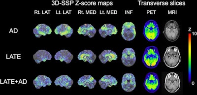 Comparison of FDG-PET 3D-SSP z-score maps and transaxial slices of the temporal lobe, along with corresponding MRI images, among individuals suspected of having Alzheimer's disease, LATE, and mixed LATE and AD co-pathology. Color-coded areas on the 3D-SSP maps represent more severe metabolic reductions. Patients with LATE and LATE+AD show a distinct pattern of decreased FDG uptake in the medial temporal lobe, whereas AD and LATE+AD show the well-known pattern of decreased FDG uptake in the posterior cingulate cortex, precuneus, and parieto-temporal association cortices.