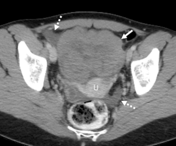 Axial contrast-enhanced CT scan in a 28-year-old premenopausal woman shows an incidentally detected solid-appearing left ovarian lesion (solid arrow) anterior to the uterus (U), associated with trace ascites in the right adnexa and cul de sac (dashed arrows). At pathologic analysis, this was shown to be ovarian dysgerminoma. Two readers misdiagnosed this lesion, one as a leiomyoma and one as an ovarian fibroma.