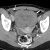Axial contrast-enhanced CT scan in a 28-year-old premenopausal woman shows an incidentally detected solid-appearing left ovarian lesion (solid arrow) anterior to the uterus (U), associated with trace ascites in the right adnexa and cul de sac (dashed arrows). At pathologic analysis, this was shown to be ovarian dysgerminoma. Two readers misdiagnosed this lesion, one as a leiomyoma and one as an ovarian fibroma.