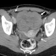 Axial contrast-enhanced CT scan in a 28-year-old premenopausal woman shows an incidentally detected solid-appearing left ovarian lesion (solid arrow) anterior to the uterus (U), associated with trace ascites in the right adnexa and cul de sac (dashed arrows). At pathologic analysis, this was shown to be ovarian dysgerminoma. Two readers misdiagnosed this lesion, one as a leiomyoma and one as an ovarian fibroma.