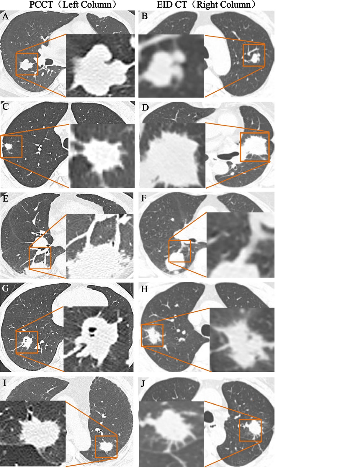 'Quadruple low' PCCT protocol improves lung cancer imaging | AuntMinnie
