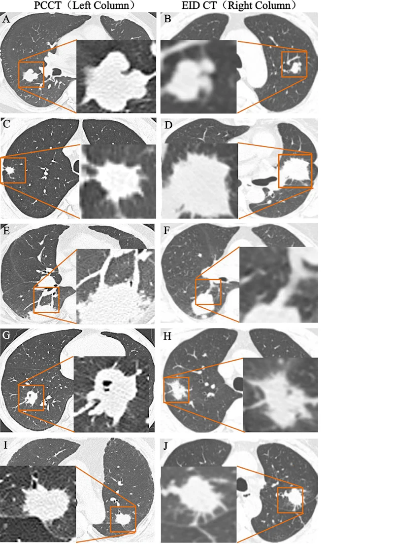 Pcc Approach Radiography 'Quadruple low' PCCT protocol improves lung cancer imaging | AuntMinnie