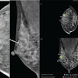 Images of a 39-year-old who underwent screening mammography. Right craniocaudal (left) and mediolateral oblique (middle) views from preoperative mammography show suspicious grouped fine pleomorphic calcifications (arrows). After biopsy showed ductal carcinoma of situ (DCIS), patient underwent breast-conserving surgery, yielding final diagnosis of ductal carcinoma in situ (intermediate grade, hormone receptor positive). (Right) Screenshot of an output of a commercial AI tool applied to preoperative mammography. AI detected right breast lesion with score of 95% on both views (concentric colored circles). Present study’s reviewing radiologist deemed AI marking to correspond with site of DCIS.