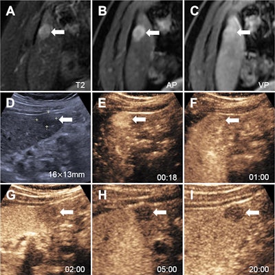 Images in a 52-year-old man with chronic hepatitis B show a nodule categorized as LR-3 at MRI using Liver Imaging Reporting and Data System (LI-RADS) version 2018 (A-C), as LR-5 at contrast-enhanced ultrasound (CEUS) using Strategy A (D-H), and as LR-5 at CEUS using Strategy B (D-I). At contrast-enhanced MRI, (A) an axial T2-weighted image in segment VI shows a 15-mm mildly hyperintense nodule (arrow). (B) The axial arterial phase shows hyperenhancement (arrow). (C) Axial portal venous phase image shows the observation with neither washout nor enhancing capsule (arrow). (D) Conventional gray-scale US in segment VI shows a 16-mm hypoechoic nodule (arrow). (E) Image shows arterial phase hyperenhancement (arrow) at 18 seconds. (F) Portal venous phase image at 1 minute shows no washout (arrow). (G, H) Late phase at 2 minutes (G) and 5 minutes (H) shows late and mild washout (arrows). (I) Kupffer-phase hypoenhancement at 20 minutes (arrow). Pathologic diagnosis based on surgical resection was hepatocellular carcinoma. AP = arterial phase, VP = venous phase.
