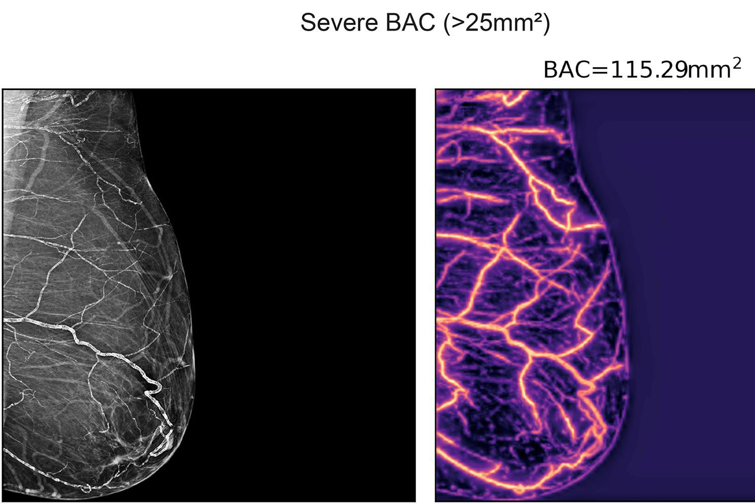 2026 03 09 Ehj Bac Mammograms Ai V2 Thumbnail
