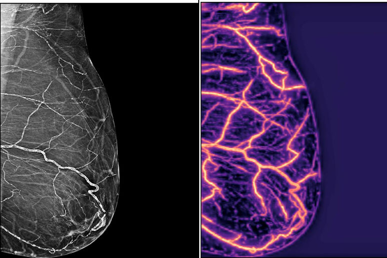 2026 03 09 Ehj Bac Mammograms Ai V2 Thumbnail3