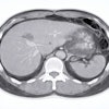 Abdominal Ct Adobe Chubby Kt