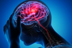 Brain Stroke Stroke Social