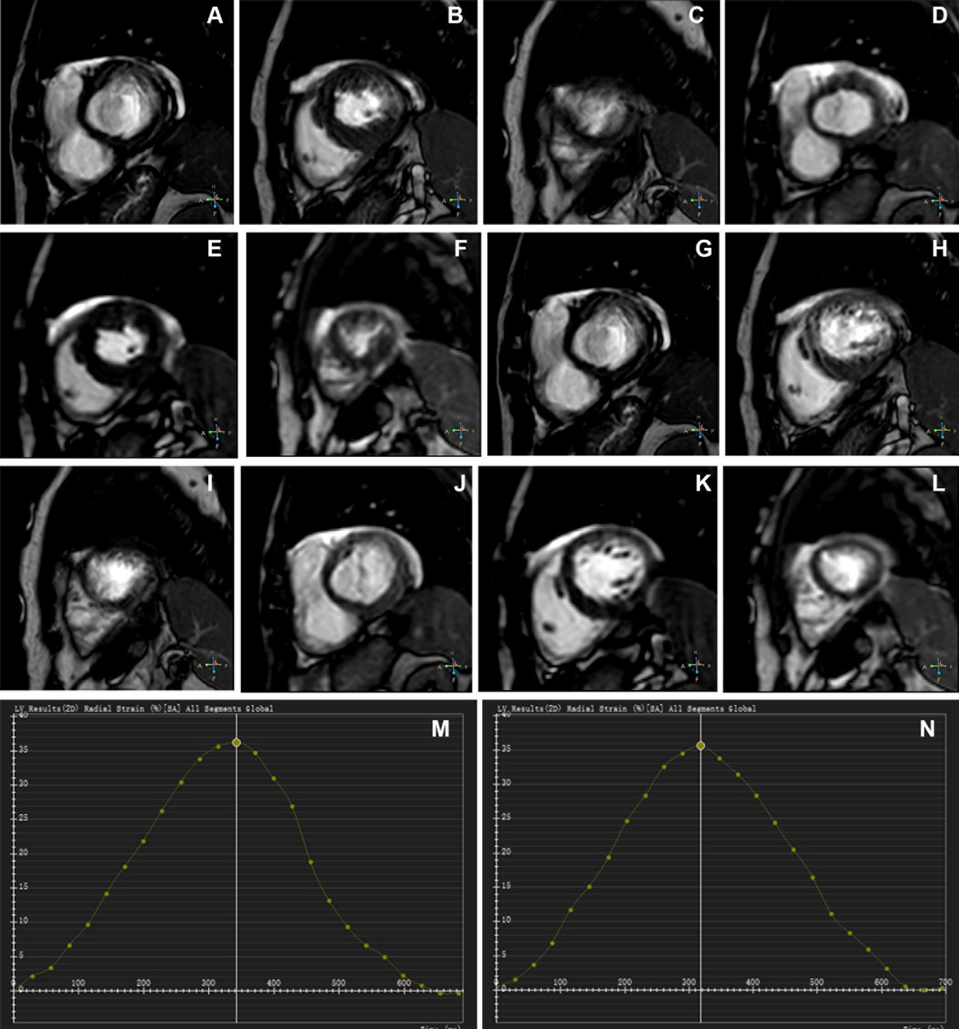 Representative images of participants with difficulty with breath holding and arrhythmia. In the lower right corner of A&ndash;L, the position coordinates of the images are marked. Short-axis (SA) view images in the end-systole (A&ndash;F) and end-diastole (G&ndash;L) phases in participants with atrial fibrillation. (A&ndash;C, G&ndash;I) Balanced steady-state free precession (bSSFP) cardiac cine. (D&ndash;F, J&ndash;L) Deep learning&ndash;enhanced compressed sensing (AI-CS) single-shot cardiac cine. In contrast to AI-CS single-shot cardiac cine, endocardial contours were challenging to identify on conventional segmented cine in midventricular and apical sections. (M) Line graph of time curve during the whole cardiac cycle obtained from bSSFP cardiac cine. (N) Line graph of time curve during the whole cardiac cycle obtained from AI-CS single-shot cardiac cine. LV = left ventricle; 2D = two-dimensional.
