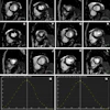 Representative images of participants with difficulty with breath holding and arrhythmia. In the lower right corner of A–L, the position coordinates of the images are marked. Short-axis (SA) view images in the end-systole (A–F) and end-diastole (G–L) phases in participants with atrial fibrillation. (A–C, G–I) Balanced steady-state free precession (bSSFP) cardiac cine. (D–F, J–L) Deep learning–enhanced compressed sensing (AI-CS) single-shot cardiac cine. In contrast to AI-CS single-shot cardiac cine, endocardial contours were challenging to identify on conventional segmented cine in midventricular and apical sections. (M) Line graph of time curve during the whole cardiac cycle obtained from bSSFP cardiac cine. (N) Line graph of time curve during the whole cardiac cycle obtained from AI-CS single-shot cardiac cine. LV = left ventricle; 2D = two-dimensional.