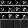 Representative images of participants with difficulty with breath holding and arrhythmia. In the lower right corner of A–L, the position coordinates of the images are marked. Short-axis (SA) view images in the end-systole (A–F) and end-diastole (G–L) phases in participants with atrial fibrillation. (A–C, G–I) Balanced steady-state free precession (bSSFP) cardiac cine. (D–F, J–L) Deep learning–enhanced compressed sensing (AI-CS) single-shot cardiac cine. In contrast to AI-CS single-shot cardiac cine, endocardial contours were challenging to identify on conventional segmented cine in midventricular and apical sections. (M) Line graph of time curve during the whole cardiac cycle obtained from bSSFP cardiac cine. (N) Line graph of time curve during the whole cardiac cycle obtained from AI-CS single-shot cardiac cine. LV = left ventricle; 2D = two-dimensional.