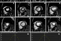 Representative images of participants with difficulty with breath holding and arrhythmia. In the lower right corner of A–L, the position coordinates of the images are marked. Short-axis (SA) view images in the end-systole (A–F) and end-diastole (G–L) phases in participants with atrial fibrillation. (A–C, G–I) Balanced steady-state free precession (bSSFP) cardiac cine. (D–F, J–L) Deep learning–enhanced compressed sensing (AI-CS) single-shot cardiac cine. In contrast to AI-CS single-shot cardiac cine, endocardial contours were challenging to identify on conventional segmented cine in midventricular and apical sections. (M) Line graph of time curve during the whole cardiac cycle obtained from bSSFP cardiac cine. (N) Line graph of time curve during the whole cardiac cycle obtained from AI-CS single-shot cardiac cine. LV = left ventricle; 2D = two-dimensional.