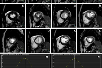 Representative images of participants with difficulty with breath holding and arrhythmia. In the lower right corner of A–L, the position coordinates of the images are marked. Short-axis (SA) view images in the end-systole (A–F) and end-diastole (G–L) phases in participants with atrial fibrillation. (A–C, G–I) Balanced steady-state free precession (bSSFP) cardiac cine. (D–F, J–L) Deep learning–enhanced compressed sensing (AI-CS) single-shot cardiac cine. In contrast to AI-CS single-shot cardiac cine, endocardial contours were challenging to identify on conventional segmented cine in midventricular and apical sections. (M) Line graph of time curve during the whole cardiac cycle obtained from bSSFP cardiac cine. (N) Line graph of time curve during the whole cardiac cycle obtained from AI-CS single-shot cardiac cine. LV = left ventricle; 2D = two-dimensional.