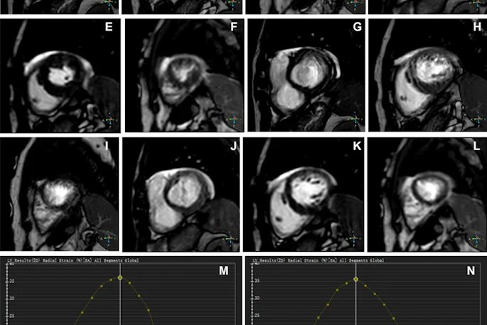 Representative images of participants with difficulty with breath holding and arrhythmia. In the lower right corner of A–L, the position coordinates of the images are marked. Short-axis (SA) view images in the end-systole (A–F) and end-diastole (G–L) phases in participants with atrial fibrillation. (A–C, G–I) Balanced steady-state free precession (bSSFP) cardiac cine. (D–F, J–L) Deep learning–enhanced compressed sensing (AI-CS) single-shot cardiac cine. In contrast to AI-CS single-shot cardiac cine, endocardial contours were challenging to identify on conventional segmented cine in midventricular and apical sections. (M) Line graph of time curve during the whole cardiac cycle obtained from bSSFP cardiac cine. (N) Line graph of time curve during the whole cardiac cycle obtained from AI-CS single-shot cardiac cine. LV = left ventricle; 2D = two-dimensional.