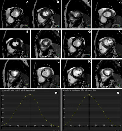 Novel AI-enhanced MRI algorithm helps assess left ventricular function