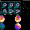 Evaluation of gated PET data using Corridor4DM. Delineations of LV borders are shown as end-diastolic (ED) frame in horizontal long axis (HLA), as end-systolic (ES) frame in HLA, as ED frame in vertical long axis (VLA), and as ES frame in VLA. Time–volume curve of LV over different phases is shown with volumetric results.
