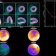 Evaluation of gated PET data using Corridor4DM. Delineations of LV borders are shown as end-diastolic (ED) frame in horizontal long axis (HLA), as end-systolic (ES) frame in HLA, as ED frame in vertical long axis (VLA), and as ES frame in VLA. Time–volume curve of LV over different phases is shown with volumetric results.
