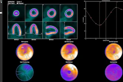Evaluation of gated PET data using Corridor4DM. Delineations of LV borders are shown as end-diastolic (ED) frame in horizontal long axis (HLA), as end-systolic (ES) frame in HLA, as ED frame in vertical long axis (VLA), and as ES frame in VLA. Time–volume curve of LV over different phases is shown with volumetric results.