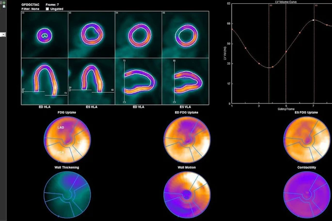 Evaluation of gated PET data using Corridor4DM. Delineations of LV borders are shown as end-diastolic (ED) frame in horizontal long axis (HLA), as end-systolic (ES) frame in HLA, as ED frame in vertical long axis (VLA), and as ES frame in VLA. Time–volume curve of LV over different phases is shown with volumetric results.