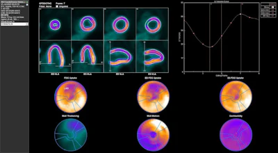 Evaluation of gated PET data using Corridor4DM. Delineations of LV borders are shown as end-diastolic (ED) frame in horizontal long axis (HLA), as end-systolic (ES) frame in HLA, as ED frame in vertical long axis (VLA), and as ES frame in VLA. Time–volume curve of LV over different phases is shown with volumetric results.