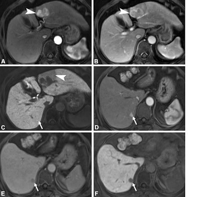 Axial gadoxetic acid-enhanced MRI scans in a 63-year-old woman with recurrent hepatocellular carcinoma (HCC) at 18 months of follow-up and a high MRI-based Early Recurrence Individualized Score (score of 11) show a 4-cm hepatic mass in liver segment 3. (A) Prominent arterial-phase hyperenhancement (arrowhead) is noted with (B) enhancing capsule (arrowhead) in the portal venous phase, consistent with HCC. (C) Hepatobiliary phase image shows nonsmooth tumor margins with wedge-shaped peritumoral hypointensity (arrowhead). The preoperative serum aspartate aminotransferase level is 32 IU/L, higher than the cutoff determined by the Youden index (29.5 IU/L). Partial hepatectomy was performed, and pathologic analysis showed conventional HCC with P53 overexpression but no microvascular invasion. The patient’s Pathology-based Early Recurrence Individualized Score is 8. At the 18-month follow-up, the arterial-phase gadoxetic acid-enhanced MRI scan shows a new focus of arterial hyperenhancement in segment 7 (arrow in D) that was absent on the preoperative MRI scan (arrow in C). The lesion shows portal venous phase washout (arrow in E) and a corresponding hepatobiliary phase defect (arrow in F), consistent with recurrent HCC.