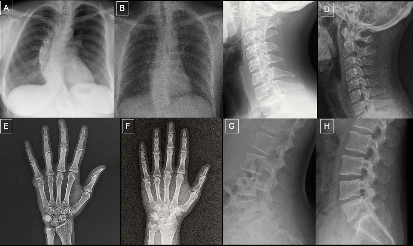 Anatomy-matched real and GPT-4o-generated radiographs: (A) real and (B) GPT-4o-generated posteroanterior chest radiographs, (C) real and (D) GPT-4ogenerated lateral cervical spine radiographs, (E) real and (F) GPT-4o-generated posteroanterior hand radiographs, and (G) real and (H) GPT-4o-generated lateral lumbar spine radiographs. The pairs demonstrate that GPT-4o can produce radiographically plausible images across different anatomic regions.