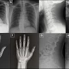 Anatomy-matched real and GPT-4o-generated radiographs: (A) real and (B) GPT-4o-generated posteroanterior chest radiographs, (C) real and (D) GPT-4ogenerated lateral cervical spine radiographs, (E) real and (F) GPT-4o-generated posteroanterior hand radiographs, and (G) real and (H) GPT-4o-generated lateral lumbar spine radiographs. The pairs demonstrate that GPT-4o can produce radiographically plausible images across different anatomic regions.