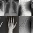 Anatomy-matched real and GPT-4o-generated radiographs: (A) real and (B) GPT-4o-generated posteroanterior chest radiographs, (C) real and (D) GPT-4ogenerated lateral cervical spine radiographs, (E) real and (F) GPT-4o-generated posteroanterior hand radiographs, and (G) real and (H) GPT-4o-generated lateral lumbar spine radiographs. The pairs demonstrate that GPT-4o can produce radiographically plausible images across different anatomic regions.