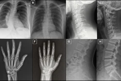Anatomy-matched real and GPT-4o-generated radiographs: (A) real and (B) GPT-4o-generated posteroanterior chest radiographs, (C) real and (D) GPT-4ogenerated lateral cervical spine radiographs, (E) real and (F) GPT-4o-generated posteroanterior hand radiographs, and (G) real and (H) GPT-4o-generated lateral lumbar spine radiographs. The pairs demonstrate that GPT-4o can produce radiographically plausible images across different anatomic regions.