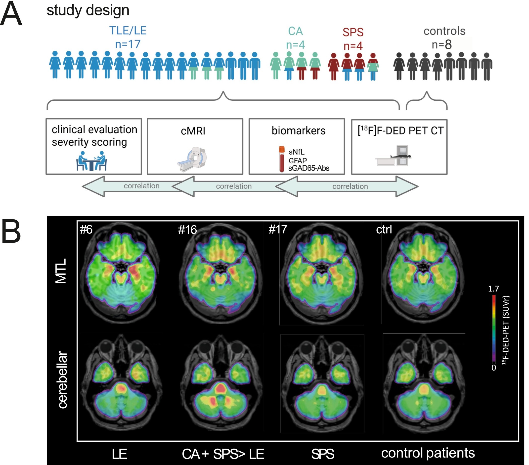 (A) Overview of study participants with different clinical phenotypes depicted in distinct colors: Limbic encephalitis (LE)/temporal lobe epilepsy (TLE): Blue; cerebellar ataxia (CA): Green; stiff person syndrome (SPS): Red, including overlapping clinical features with an overview of the analyzed parameter; generated in Biorender. (B) F-18 F-DED uptake, as visualized by SUVr with global mean scaling, is shown for three representative patients with GAD65-AIE: Patient #6 with LE/TLE, showing mesiotemporal F-18 F-DED uptake; patient #16 with overlapping clinical features of CA, SPS, and LE, showing both mesiotemporal and cerebellar F-18 F-DED uptake; and patient #17 with isolated SPS showing no increased F-18 F-DED uptake. Additionally, the average F-18 F-DED uptake of eight controls is shown on the right.