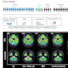 (A) Overview of study participants with different clinical phenotypes depicted in distinct colors: Limbic encephalitis (LE)/temporal lobe epilepsy (TLE): Blue; cerebellar ataxia (CA): Green; stiff person syndrome (SPS): Red, including overlapping clinical features with an overview of the analyzed parameter; generated in Biorender. (B) F-18 F-DED uptake, as visualized by SUVr with global mean scaling, is shown for three representative patients with GAD65-AIE: Patient #6 with LE/TLE, showing mesiotemporal F-18 F-DED uptake; patient #16 with overlapping clinical features of CA, SPS, and LE, showing both mesiotemporal and cerebellar F-18 F-DED uptake; and patient #17 with isolated SPS showing no increased F-18 F-DED uptake. Additionally, the average F-18 F-DED uptake of eight controls is shown on the right.