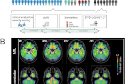 (A) Overview of study participants with different clinical phenotypes depicted in distinct colors: Limbic encephalitis (LE)/temporal lobe epilepsy (TLE): Blue; cerebellar ataxia (CA): Green; stiff person syndrome (SPS): Red, including overlapping clinical features with an overview of the analyzed parameter; generated in Biorender. (B) F-18 F-DED uptake, as visualized by SUVr with global mean scaling, is shown for three representative patients with GAD65-AIE: Patient #6 with LE/TLE, showing mesiotemporal F-18 F-DED uptake; patient #16 with overlapping clinical features of CA, SPS, and LE, showing both mesiotemporal and cerebellar F-18 F-DED uptake; and patient #17 with isolated SPS showing no increased F-18 F-DED uptake. Additionally, the average F-18 F-DED uptake of eight controls is shown on the right.