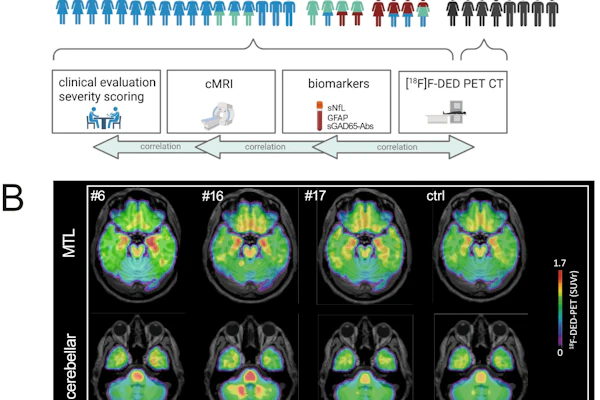 (A) Overview of study participants with different clinical phenotypes depicted in distinct colors: Limbic encephalitis (LE)/temporal lobe epilepsy (TLE): Blue; cerebellar ataxia (CA): Green; stiff person syndrome (SPS): Red, including overlapping clinical features with an overview of the analyzed parameter; generated in Biorender. (B) F-18 F-DED uptake, as visualized by SUVr with global mean scaling, is shown for three representative patients with GAD65-AIE: Patient #6 with LE/TLE, showing mesiotemporal F-18 F-DED uptake; patient #16 with overlapping clinical features of CA, SPS, and LE, showing both mesiotemporal and cerebellar F-18 F-DED uptake; and patient #17 with isolated SPS showing no increased F-18 F-DED uptake. Additionally, the average F-18 F-DED uptake of eight controls is shown on the right.