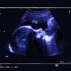 Fetal Ultrasound