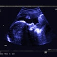 Fetal Ultrasound