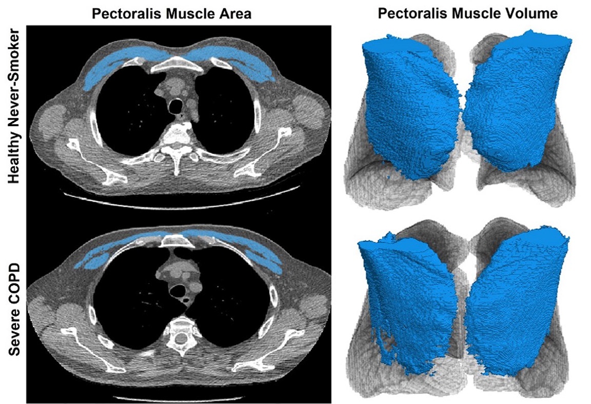 Images show the pectoralis muscles of a healthy male individual who never smoked (age, 66 years; height, 178 cm; body mass index [BMI, calculated as weight in kilograms divided by height in meters squared], 28.4; number of cigarette pack-years, 0; forced expiratory volume in 1 second [FEV1], 97.6% predicted; FEV1: forced vital capacity [FVC] ratio, 0.71; pectoralis muscle area [PMA], 59.4 cm2; pectoralis muscle volume [PMV], 764 cm3) and a male individual with a smoking history and chronic obstructive pulmonary disorder (COPD) (age, 66 years; height, 178 cm; BMI, 27.5; number of cigarette pack-years, 43.2, FEV1, 48% predicted; FEV1:FVC, 0.56; PMA, 35 cm2; PMV, 480.8 cm3) from the Canadian Cohort Obstructive Lung Disease (i.e., CanCOLD) study. The CT image is shown in the axial plane. The PMV is automatically extracted using the developed deep learning model and overlayed onto the lungs for visual clarity.