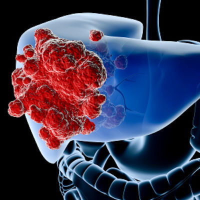 Liver Cancer 400