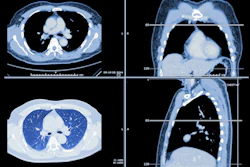 Lung Ct Images 400